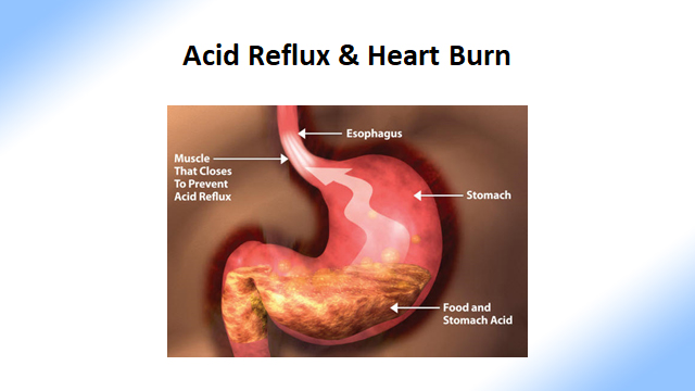 Chiropractic Shelburne VT Acid Reflux