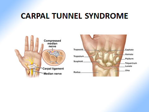 Chiropractic Shelburne VT Carpal Tunnel Syndrome