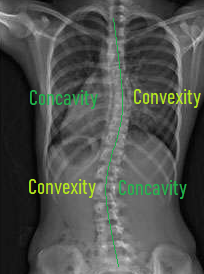 Chiropractic Shelburne VT Scoliosis (2)