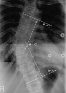 Chiropractic Shelburne VT Scoliosis (3)